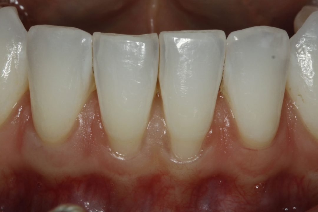 before gum grafts | Precision Periodontics