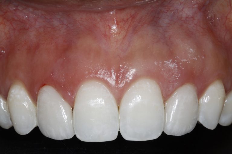 gummy smiles after | Precision Periodontics